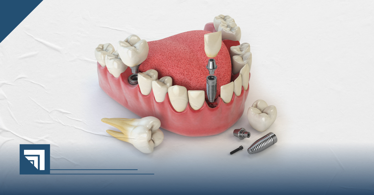 Universidad Cuauhtémoc Querétaro Diplomado en Implantología 